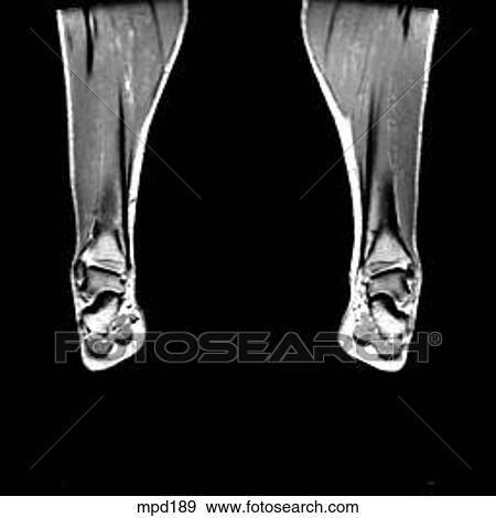 Lower Legs and Feet - Coronal View Large Illustration Stock Illustration - Lower Legs and Feet - Coronal. Fotosearch