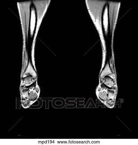 Lower Legs and Feet - Coronal View Large Illustration Stock Illustration - Lower Legs and Feet - Coronal. Fotosearch