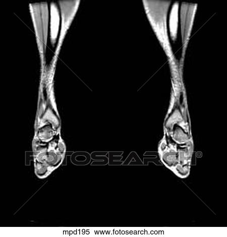 Lower Legs and Feet - Coronal View Large Illustration Stock Illustration - Lower Legs and Feet - Coronal. Fotosearch