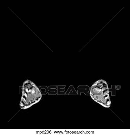 Lower Legs and Feet - Coronal View Large Illustration Stock Illustration - Lower Legs and Feet - Coronal. Fotosearch