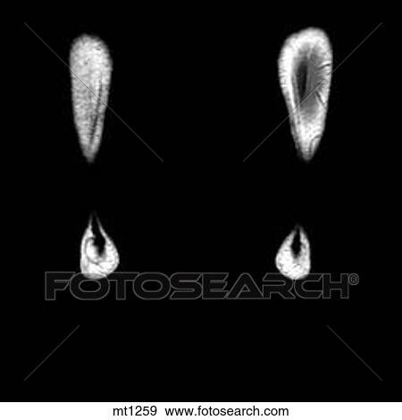 Stock Illustration - Lower Legs and Feet - Coronal. Fotosearch