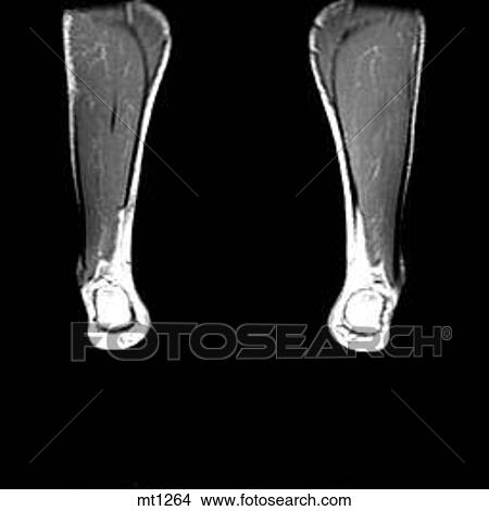 Stock Illustration - Lower Legs and Feet - Coronal. Fotosearch