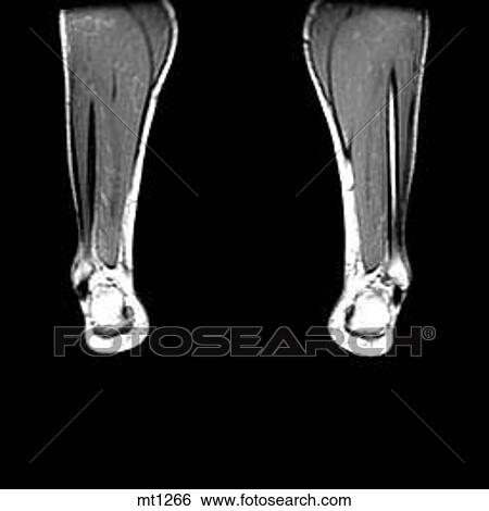 Stock Illustration - Lower Legs and Feet - Coronal. Fotosearch