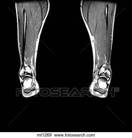 Stock Illustration - Lower Legs and Feet - Coronal. Fotosearch