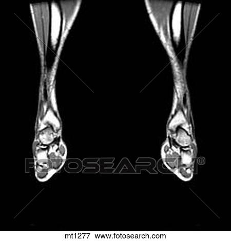 Stock Illustration - Lower Legs and Feet - Coronal. Fotosearch