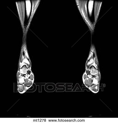 Lower Legs and Feet - Coronal View Large Illustration Stock Illustration - Lower Legs and Feet - Coronal. Fotosearch