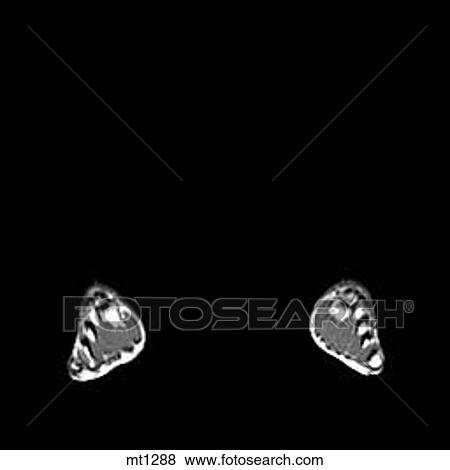 Stock Illustration - Lower Legs and Feet - Coronal. Fotosearch