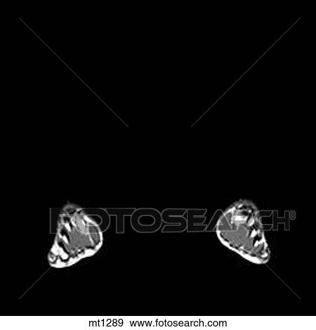 Stock Illustration - Lower Legs and Feet - Coronal. Fotosearch