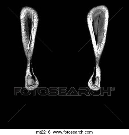 Lower Legs and Feet - Coronal View Large Illustration Stock Illustration - Lower Legs and Feet - Coronal. Fotosearch