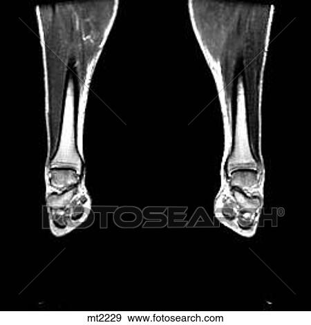 Stock Illustration - Lower Legs and Feet - Coronal. Fotosearch
