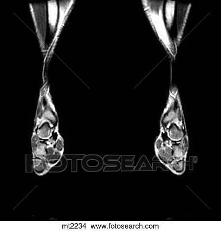 Lower Legs and Feet - Coronal View Large Illustration Stock Illustration - Lower Legs and Feet - Coronal. Fotosearch