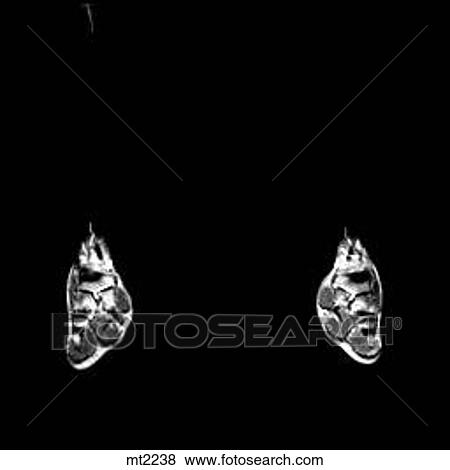 Lower Legs and Feet - Coronal View Large Illustration Stock Illustration - Lower Legs and Feet - Coronal. Fotosearch