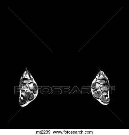 Lower Legs and Feet - Coronal View Large Illustration Stock Illustration - Lower Legs and Feet - Coronal. Fotosearch