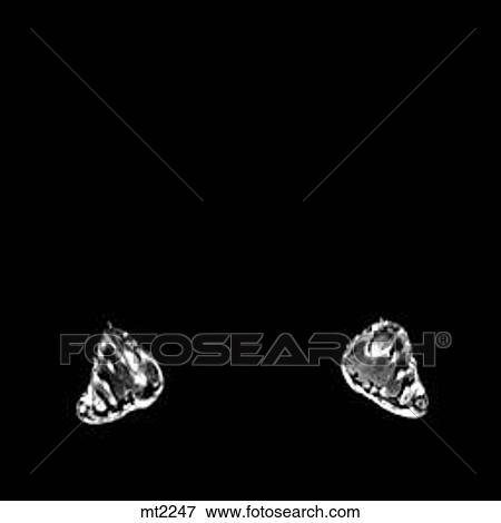 Lower Legs and Feet - Coronal View Large Illustration Stock Illustration - Lower Legs and Feet - Coronal. Fotosearch