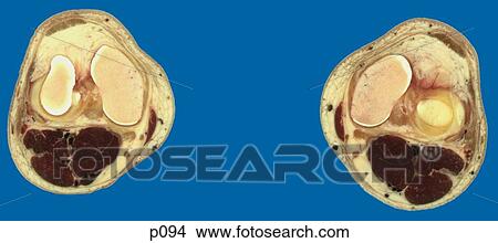 Stock Illustration - Thighs - Knee. Fotosearch