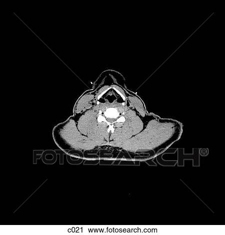 Clip Art - Thorax. Fotosearch