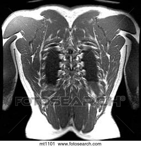 Clip Art - Thorax - Coronal. Fotosearch