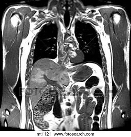 Thorax - Coronal View Large Illustration Clip Art - Thorax - Coronal. Fotosearch