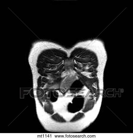 Clip Art - Thorax - Coronal. Fotosearch