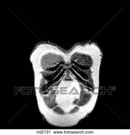 Clip Art - Thorax - Coronal. Fotosearch
