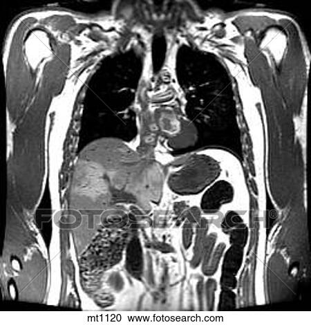 Clipart - Thorax - Coronal. Fotosearch