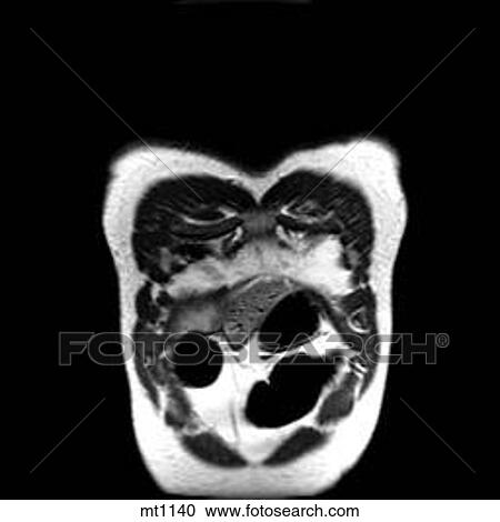 Clipart - Thorax - Coronal. Fotosearch