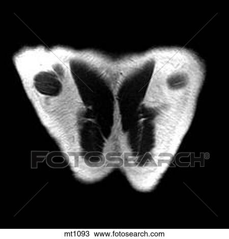 Drawing - Thorax - Coronal. Fotosearch
