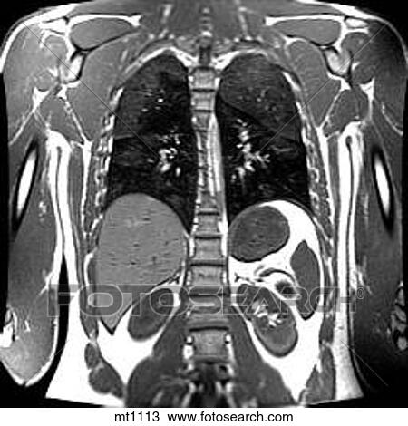 Drawing - Thorax - Coronal. Fotosearch