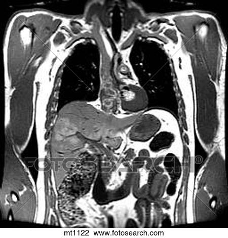 Thorax - Coronal View Large Illustration Drawing - Thorax - Coronal. Fotosearch