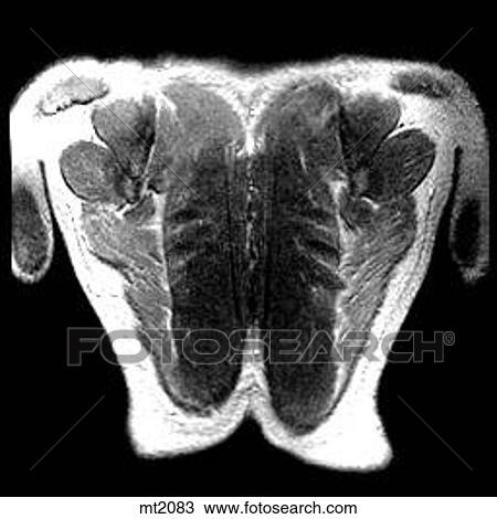 Drawing - Thorax - Coronal. Fotosearch