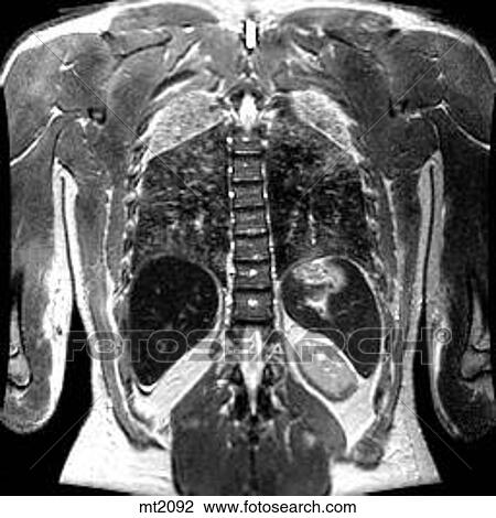 Drawing - Thorax - Coronal. Fotosearch