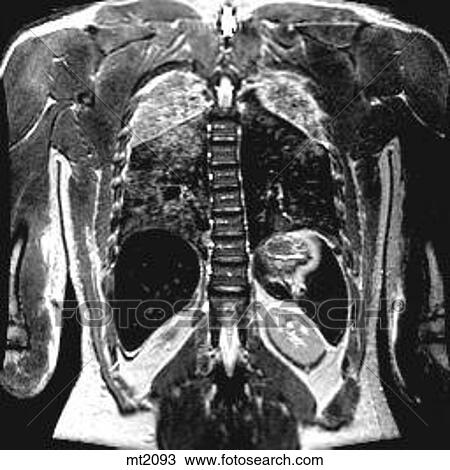 Drawing - Thorax - Coronal. Fotosearch