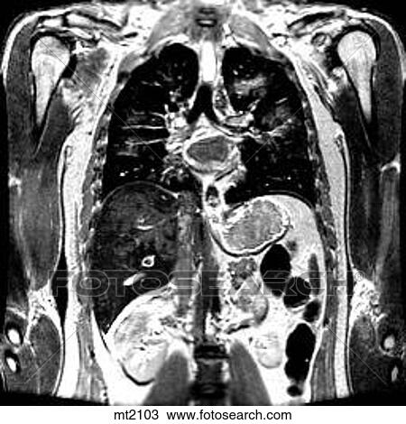 Drawing - Thorax - Coronal. Fotosearch