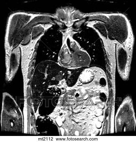 Drawing - Thorax - Coronal. Fotosearch