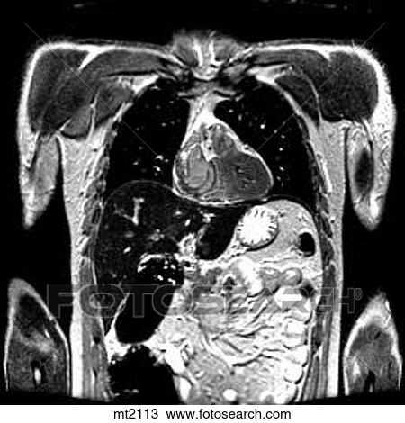 Thorax - Coronal View Large Illustration Drawing - Thorax - Coronal. Fotosearch