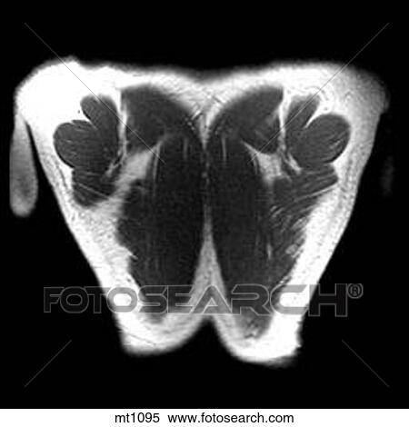 Thorax - Coronal View Large Illustration Stock Illustration - Thorax - Coronal. Fotosearch