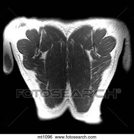 Stock Illustration - Thorax - Coronal. Fotosearch