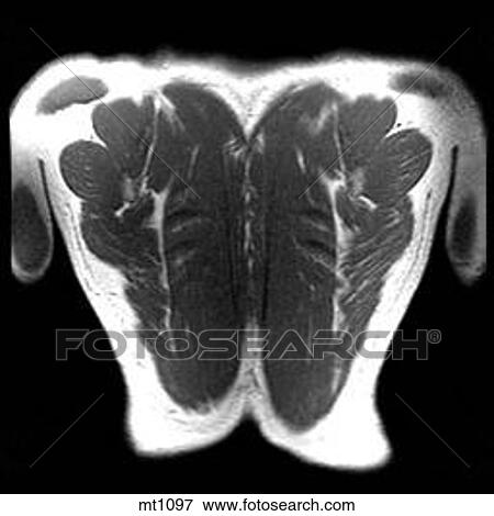 Thorax - Coronal View Large Illustration Stock Illustration - Thorax - Coronal. Fotosearch