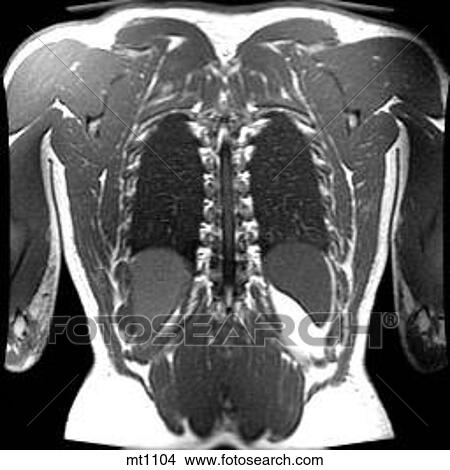 Stock Illustration - Thorax - Coronal. Fotosearch