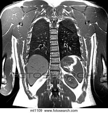 Stock Illustration - Thorax - Coronal. Fotosearch
