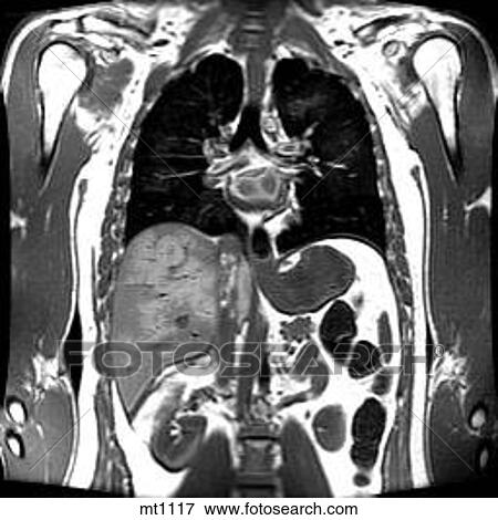 Stock Illustration - Thorax - Coronal. Fotosearch