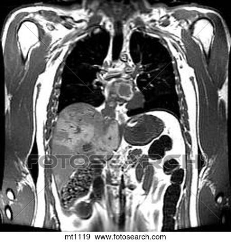Thorax - Coronal View Large Illustration Stock Illustration - Thorax - Coronal. Fotosearch