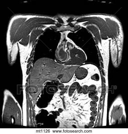 Stock Illustration - Thorax - Coronal. Fotosearch