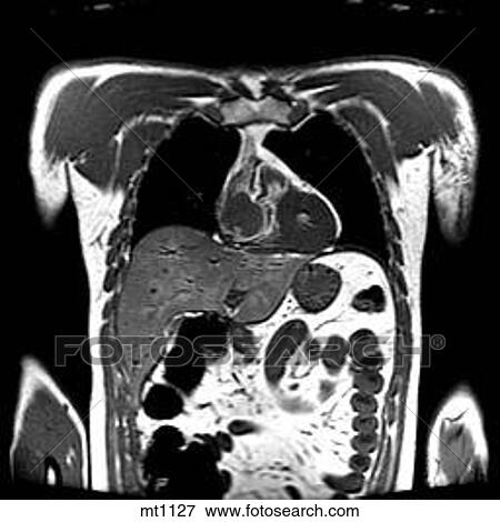 Stock Illustration - Thorax - Coronal. Fotosearch