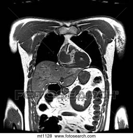 Stock Illustration - Thorax - Coronal. Fotosearch