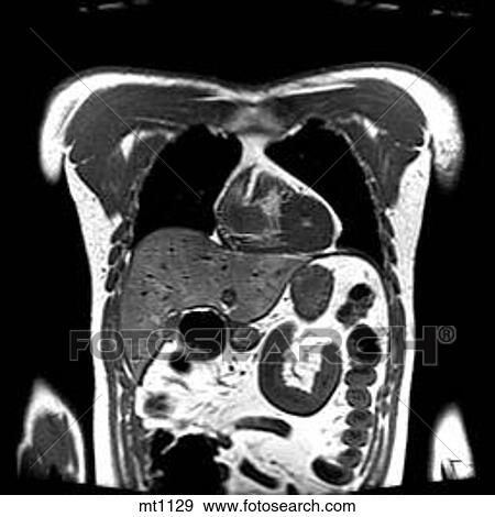Thorax - Coronal View Large Illustration Stock Illustration - Thorax - Coronal. Fotosearch