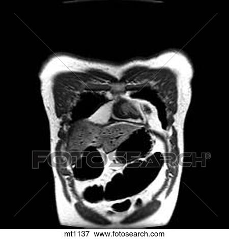 Stock Illustration - Thorax - Coronal. Fotosearch