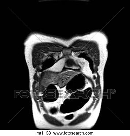 Stock Illustration - Thorax - Coronal. Fotosearch