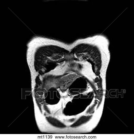 Stock Illustration - Thorax - Coronal. Fotosearch