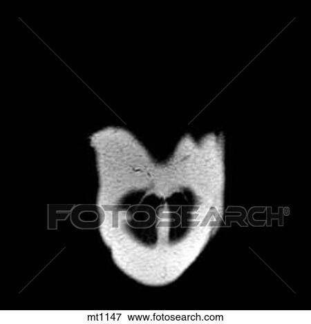 Stock Illustration - Thorax - Coronal. Fotosearch